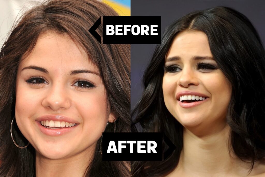 Selena Gomez after dental work